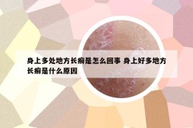 身上多處地方長癬是怎么回事 身上好多地方長癬是什么原因