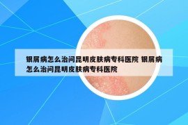 銀屑病怎么治問昆明皮膚病專科醫(yī)院 銀屑病怎么治問昆明皮膚病?？漆t(yī)院