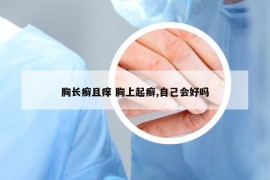 胸長癬且癢 胸上起癬,自己會(huì)好嗎