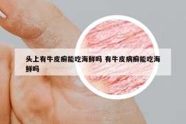 頭上有牛皮癬能吃海鮮嗎 有牛皮病癬能吃海鮮嗎