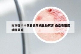 南京哪個中醫(yī)看銀屑病比較厲害 南京看銀屑病哪里好