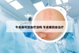 牛皮癬可放血療法嗎 牛皮廨放血治療