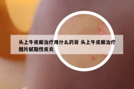 頭上牛皮廨治療用什么藥膏 頭上牛皮廨治療圖片膩脂性皮炎