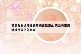 男朋友有遺傳性銀屑病該結(jié)婚么 男友有銀屑病被傳染了怎么辦
