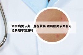 銀屑病關(guān)節(jié)炎一直在發(fā)展 銀屑病關(guān)節(jié)炎有可能長期不復(fù)發(fā)嗎