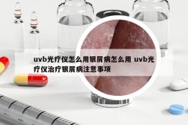 uvb光療儀怎么用銀屑病怎么用 uvb光療儀治療銀屑病注意事項
