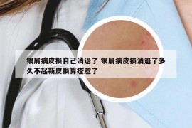 銀屑病皮損自己消退了 銀屑病皮損消退了多久不起新皮損算痊愈了