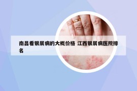 南昌看銀屑病的大概價格 江西銀屑病醫(yī)院排名