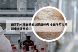四歲的小孩有癬能涂酮康唑嗎 小孩子可以用酮康唑外用嗎