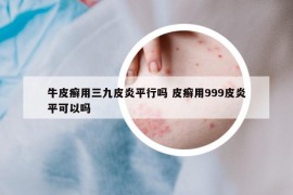 牛皮癬用三九皮炎平行嗎 皮癬用999皮炎平可以嗎