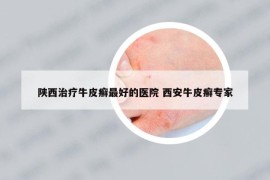 陜西治療牛皮癬最好的醫(yī)院 西安牛皮癬專家