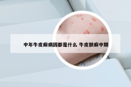 中年牛皮癬病因都是什么 牛皮膚癬中期