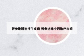 苦參泡醋治療牛皮癬 苦參這味中藥治療皮癬