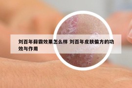劉百年蘚霸效果怎么樣 劉百年皮膚偏方的功效與作用