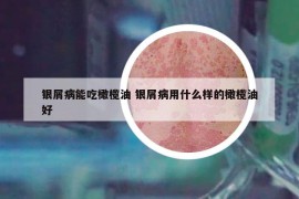 銀屑病能吃橄欖油 銀屑病用什么樣的橄欖油好