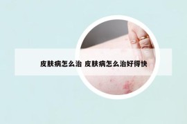 皮膚病怎么治 皮膚病怎么治好得快