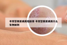 尋常型銀屑病用地耐得 尋常型銀屑病用什么生物制劑