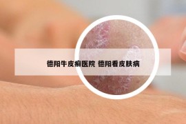 德陽牛皮癬醫(yī)院 德陽看皮膚病
