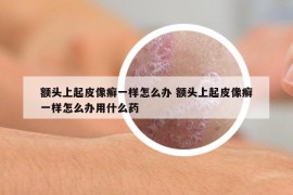 額頭上起皮像癬一樣怎么辦 額頭上起皮像癬一樣怎么辦用什么藥