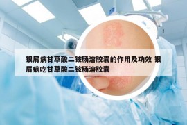 銀屑病甘草酸二銨腸溶膠囊的作用及功效 銀屑病吃甘草酸二銨腸溶膠囊