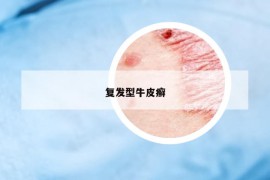 復(fù)發(fā)型牛皮癬