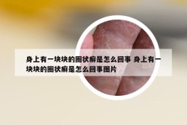身上有一塊塊的圈狀癬是怎么回事 身上有一塊塊的圈狀癬是怎么回事圖片