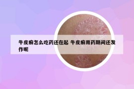 牛皮癬怎么吃藥還在起 牛皮癬用藥期間還發(fā)作呢