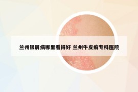 蘭州銀屑病哪里看得好 蘭州牛皮癬?？漆t(yī)院
