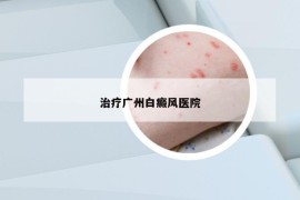 治療廣州白癜風(fēng)醫(yī)院