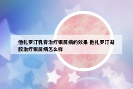 他扎羅汀乳膏治療銀屑病的效果 他扎羅汀凝膠治療銀屑病怎么樣