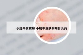 小腿牛皮膚癬 小腿牛皮膚癬用什么藥