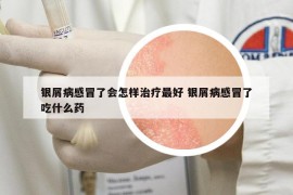 銀屑病感冒了會(huì)怎樣治療最好 銀屑病感冒了吃什么藥