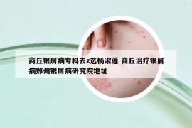 商丘銀屑病?？迫選楊淑蓮 商丘治療銀屑病鄭州銀屑病研究院地址