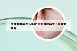頭部皮膚癬怎么治療 頭部皮膚癬怎么治療效果好
