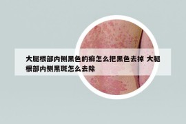 大腿根部內(nèi)側(cè)黑色的癬怎么把黑色去掉 大腿根部內(nèi)側(cè)黑斑怎么去除