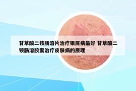 甘草酸二銨腸溶片治療銀屑病最好 甘草酸二銨腸溶膠囊治療皮膚病的原理