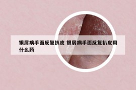 銀屑病手面反復(fù)扒皮 銀屑病手面反復(fù)扒皮用什么藥