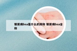銀屑病bsa是什么的簡(jiǎn)稱(chēng) 銀屑病bsa全稱(chēng)