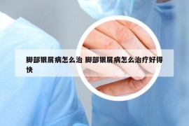 腳部銀屑病怎么治 腳部銀屑病怎么治療好得快