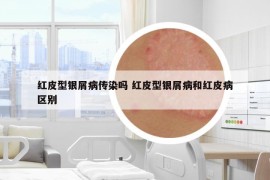 紅皮型銀屑病傳染嗎 紅皮型銀屑病和紅皮病區(qū)別