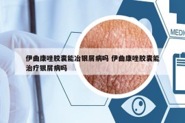 伊曲康唑膠囊能冶銀屑病嗎 伊曲康唑膠囊能治療銀屑病嗎