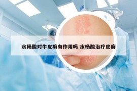 水楊酸對(duì)牛皮癬有作用嗎 水楊酸治療皮癬