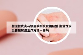脂溢性皮炎與銀屑病的皮膚鏡區(qū)別 脂溢性皮炎和銀屑病治療方法一樣嗎
