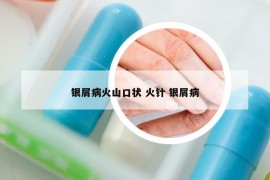 銀屑病火山口狀 火針 銀屑病