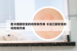 他卡西醇軟膏的功效和作用 卡泊三醇軟膏的功效和作用