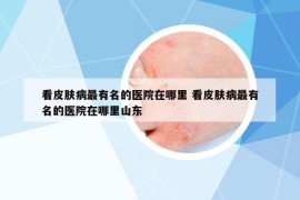 看皮膚病最有名的醫(yī)院在哪里 看皮膚病最有名的醫(yī)院在哪里山東