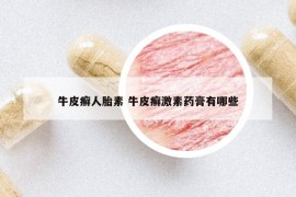 牛皮癬人胎素 牛皮癬激素藥膏有哪些