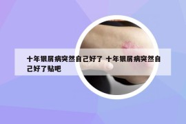 十年銀屑病突然自己好了 十年銀屑病突然自己好了貼吧