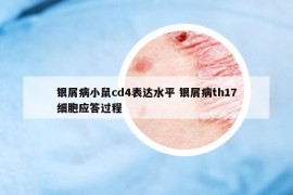 銀屑病小鼠cd4表達(dá)水平 銀屑病th17細(xì)胞應(yīng)答過程