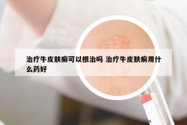 治療牛皮膚癬可以根治嗎 治療牛皮膚癬用什么藥好